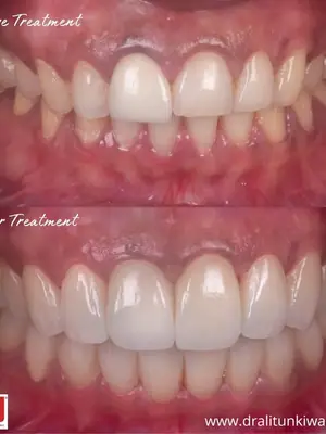 Functional Occlusion & Full Mouth Rehabilitation poster