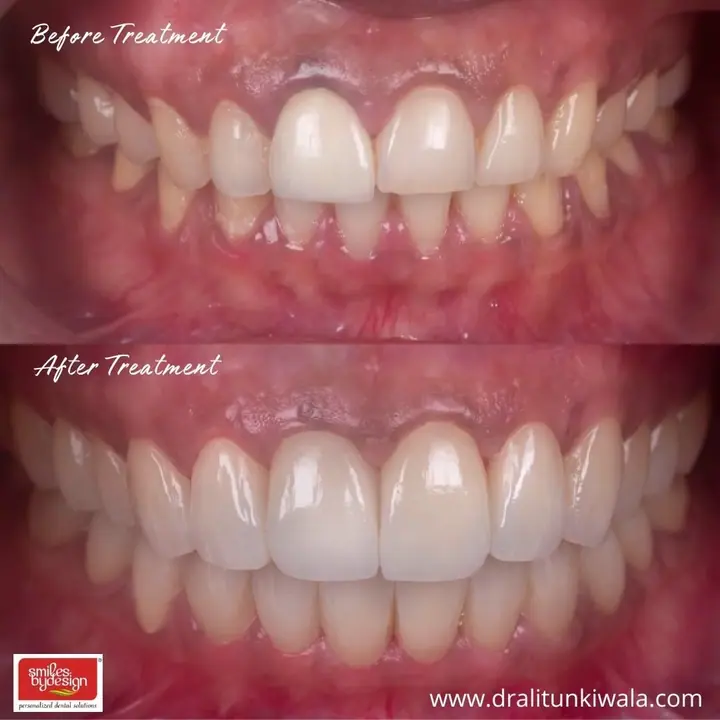 Functional Occlusion & Full Mouth Rehabilitation poster